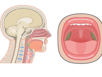 Sagittal view of the head and neck (left side) and the oral cavity (right side) showing the tonsils highlighted with green