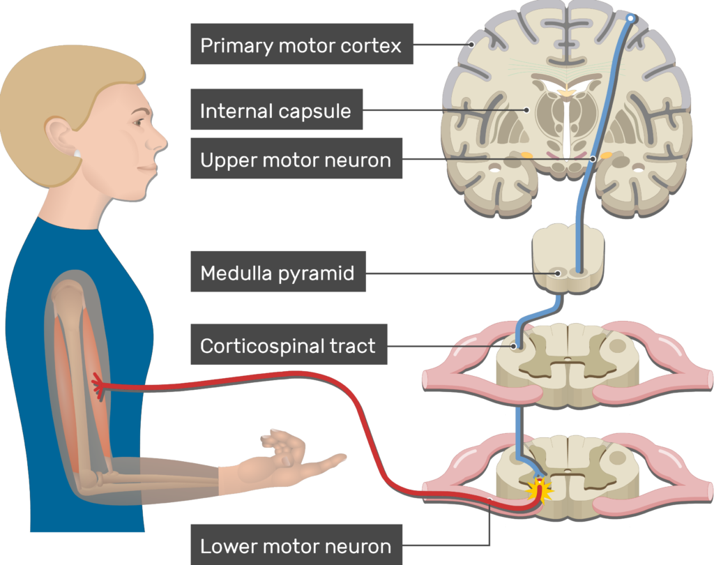 An image showing action potential moving through the lower motor neuron, Pyramidal Tract Pathway (Internal capsule, Corticospinal tract, Medulla pyramid, Primary motor cortex, Upper motor neuron, Lower motor neuron)