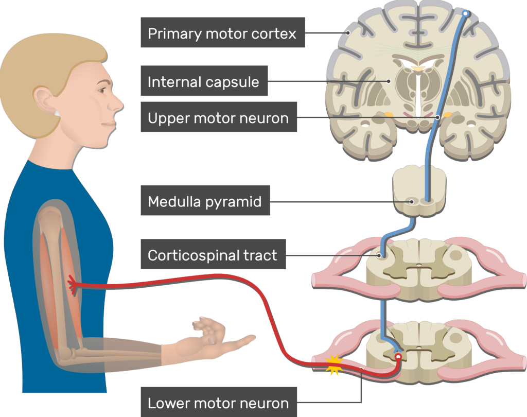 An image showing action potential moving through the lower motor neuron, Pyramidal Tract Pathway (Internal capsule, Corticospinal tract, Medulla pyramid, Primary motor cortex, Upper motor neuron, Lower motor neuron)