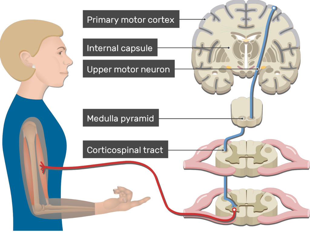 An image showing action potential moving through the upper motor neuron, Pyramidal Tract Pathway (Internal capsule, Corticospinal tract, Medulla pyramid, Primary motor cortex, Upper motor neuron, Lower motor neuron)