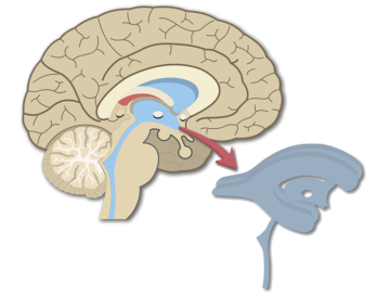 An image showing the Brain Ventricles in Midsagittal view
