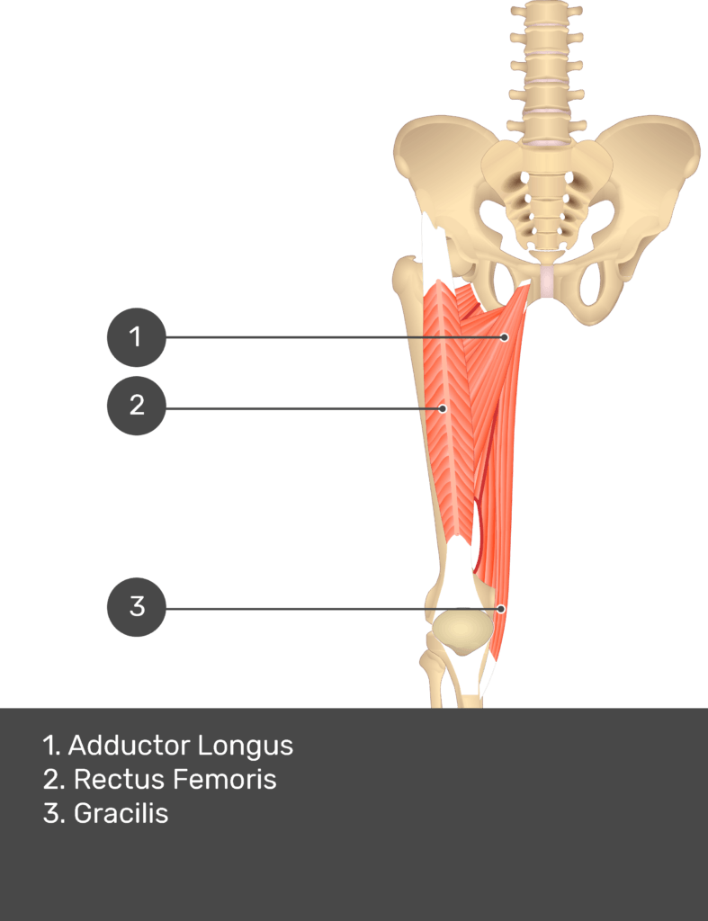 A quiz image of the anterior view of the thigh, pelvis and lower section of the vertebral column. The muscles of the anterior thigh are numbered 1 to 3. The answers revealed at the bottom are as follows 1. Adductor Longus 2. Rectus Femoris 3. Gracilis.
