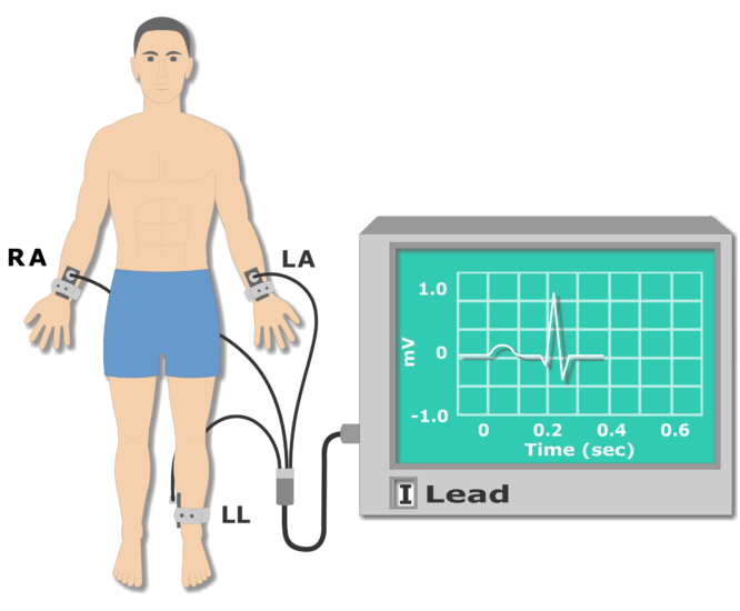 ECG Electrode Placement GetBodySmart