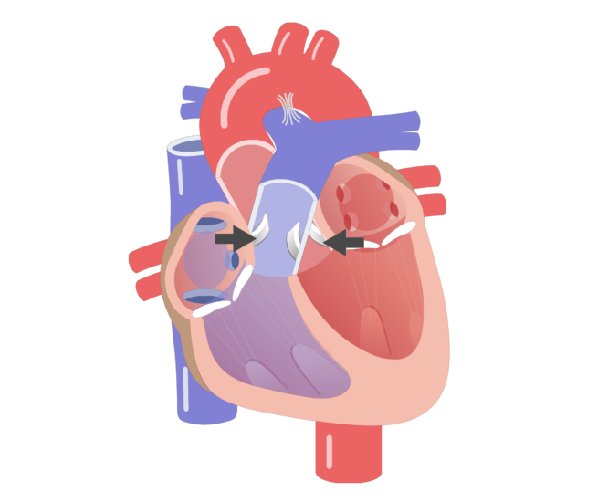 Heart Valve Movement