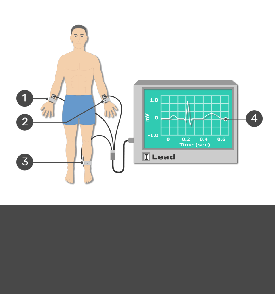 Tes yourself image for the placement of ECG electrodes with answers hidden.
