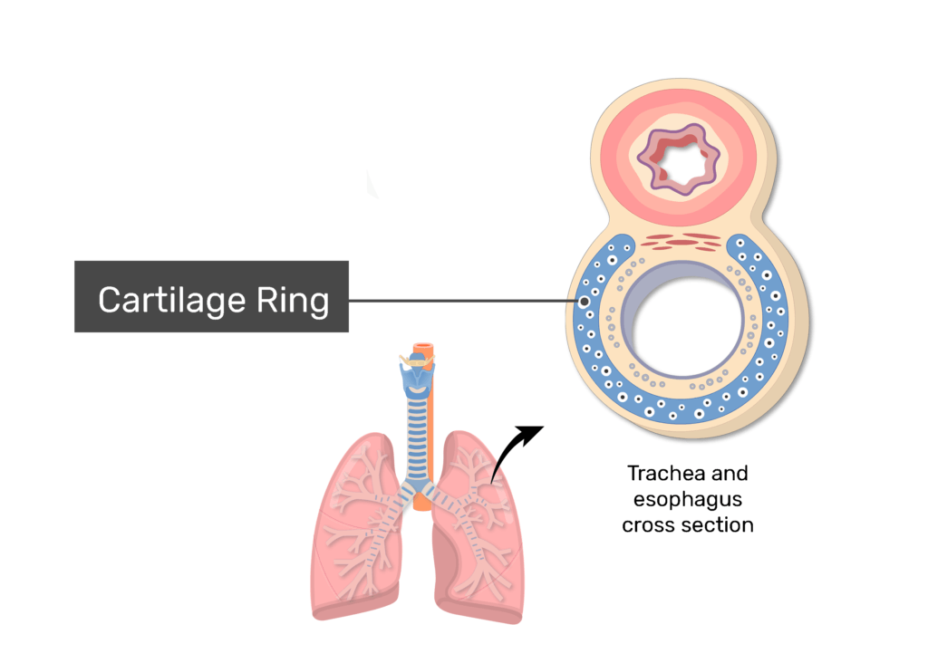 trachea - CLASSIFICATION OF TRACHEOSTOMY - Dr. Meenesh Juvekar - ENT  Specialist