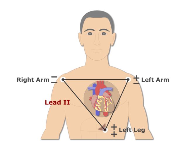ECG Electrode Placement GetBodySmart