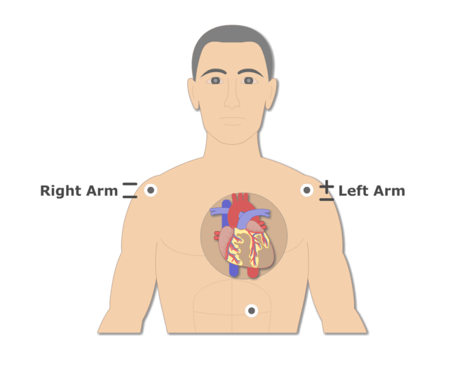 ECG Electrode Placement GetBodySmart