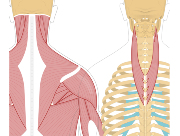 Featured image showing two views of the posterior view of the occipital region of the skull, cervical and thoracic regions of the spinal column, upper arm and scapulae. The image on the left shows the bony elements and the muscles of the back and next, the image on the right shows isolated Splenius Cervicis Muscle.