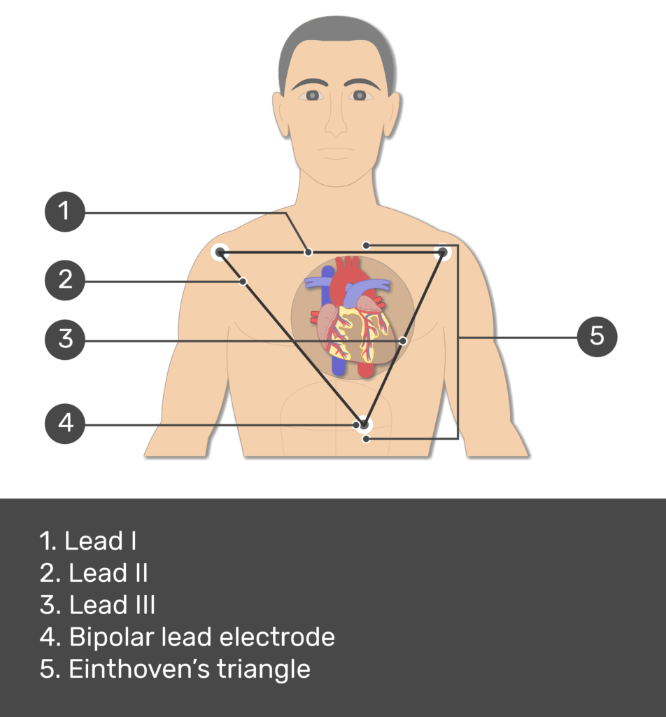 Test yourself image for the standard bipolar ecg lead electrodes with answers shown; lead i, lead ii, lead iii, bipolar lead electrode, einthoven's triangle.